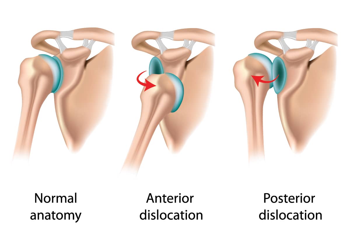 Joint Dislocation